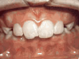Overjet - Protruding front teeth before