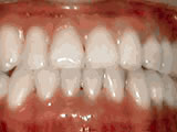 Underbite - Lower front teeth in front of upper teeth after